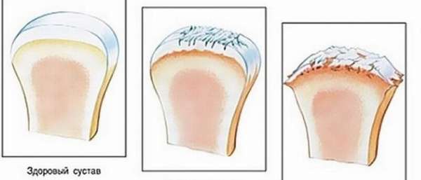 Причины и лечение остеоартроза суставов
